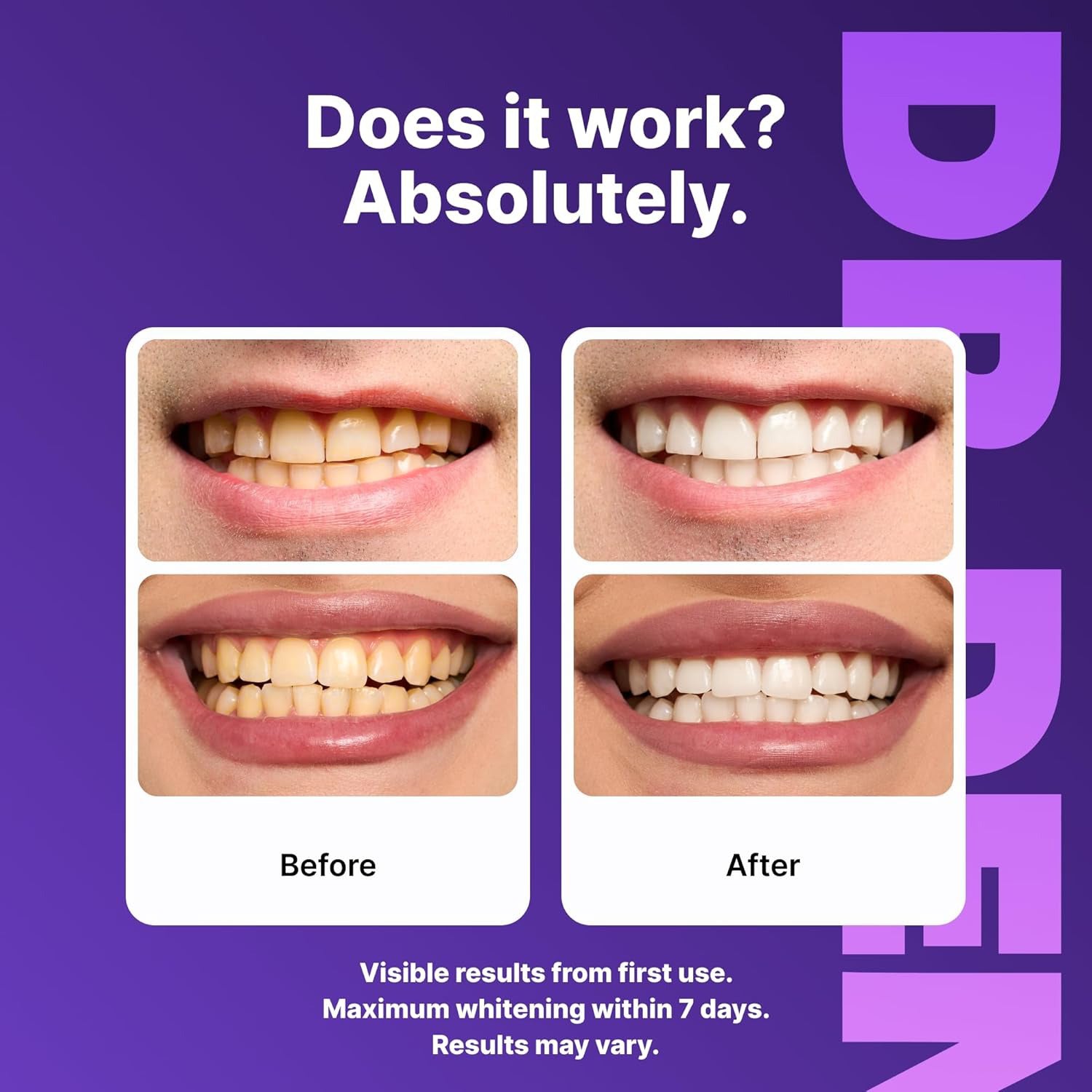 Dr.Dent Purple Teeth Whitening Strips ( 2nd Generation - Advanced Technology )